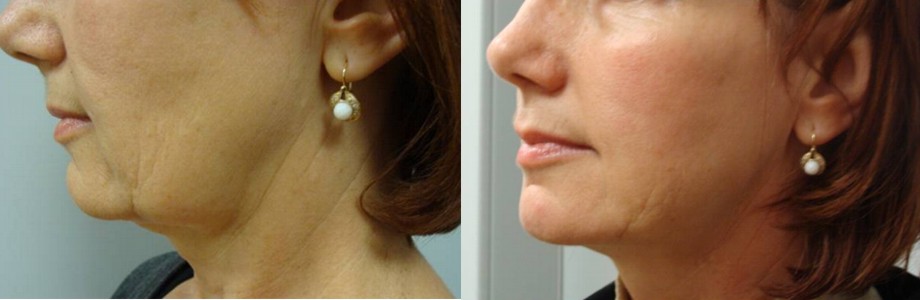 Neck liposuction